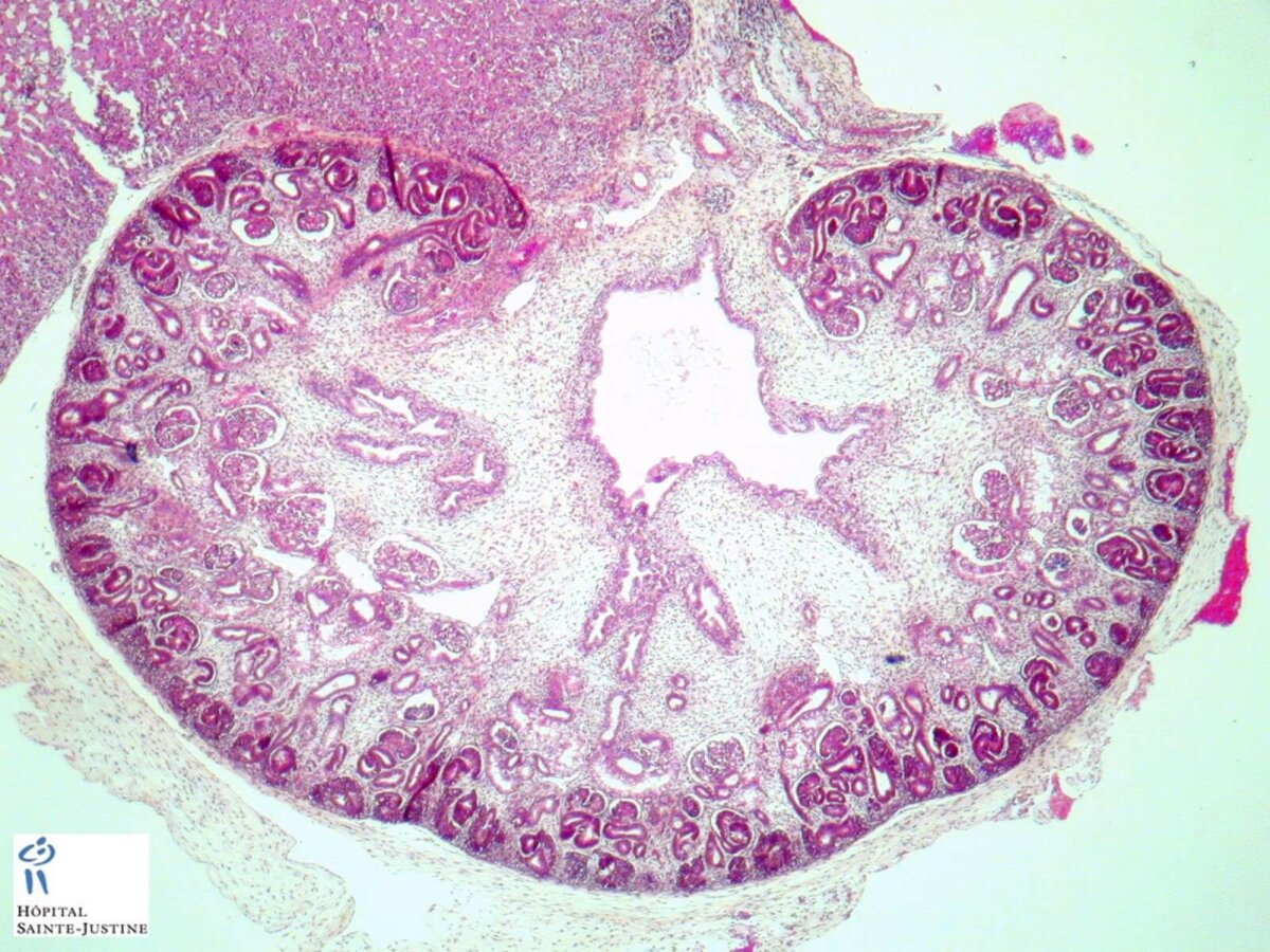 El riñón del feto puede verse afectado por la pielectasia renal.