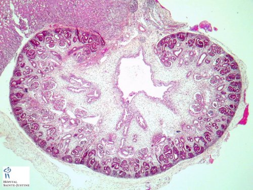 ¿Qué es la ectasia piélica fetal?