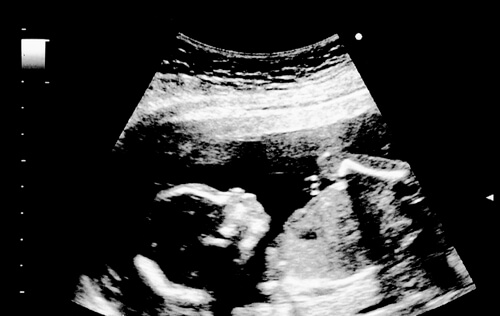 Ultrasonido de la semana 18 del embarazo.