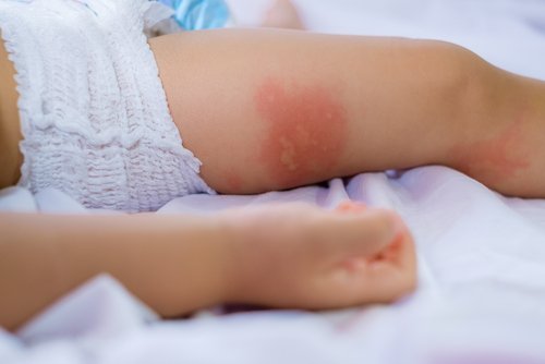 Las alergias alimentarias comunes en bebés producen urticaria y manchas.