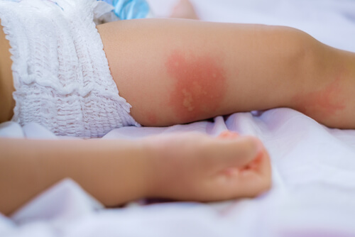 Alergias alimentarias en niños.