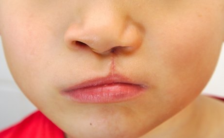 Los niños con labio leporino a veces presentan problemas de habla.