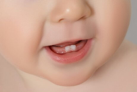 A baby's first teeth, representing what should you do if your baby hasn't started teething.