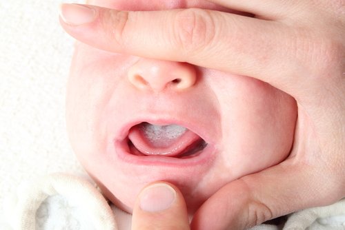 La lengua blanca es una señal del Muguet en bebés.
