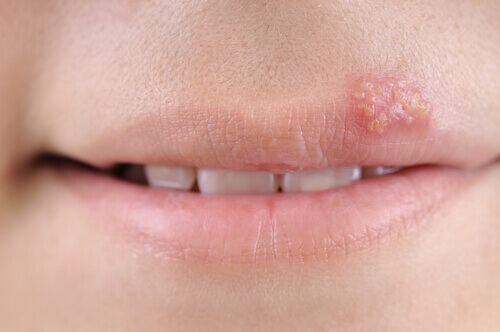 El herpes labial es sumamente contagioso.