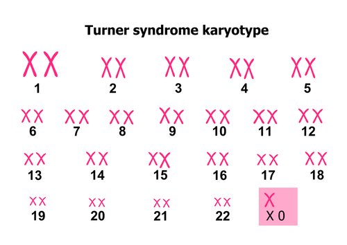 El síndrome de Turner es causado por la ausencia de un cromosoma X.