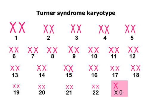 ¿qué Es El Síndrome De Turner Eres Mamáemk 9576