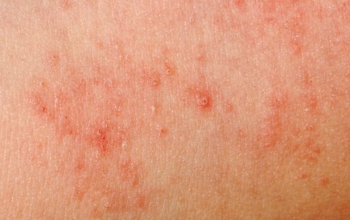 La alergia al sudor en niños se potencia con el uso de ciertos productos químicos.