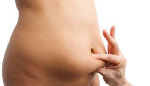 La diástasis de los rectos abdominales.