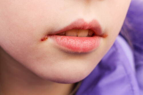 Las boqueras en niños: causas y tratamiento