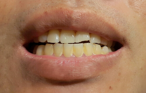 Aparición de manchas en los dientes definitivos