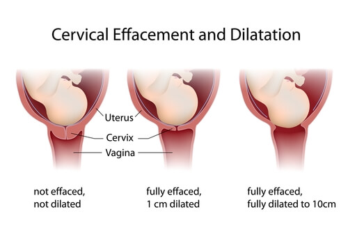 Le processus de dilatation peut prendre plusieurs heures.
