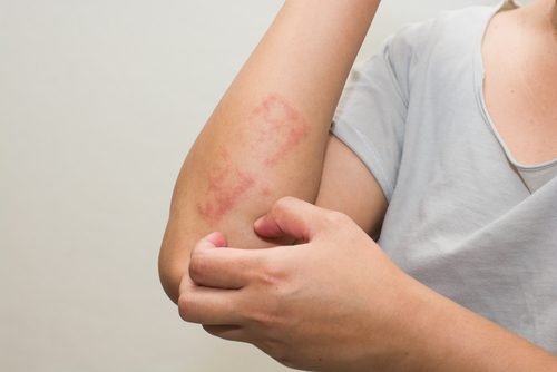 La psoriasis a veces resulta difícil de identificar.