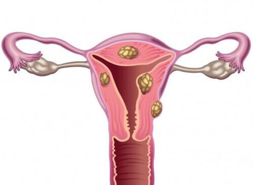 Los miomas uterinos y la infertilidad