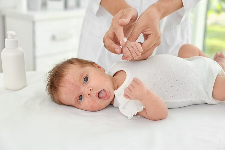 Bebé con dermatitis