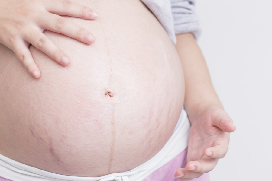 Cómo prevenir las estrías durante el embarazo