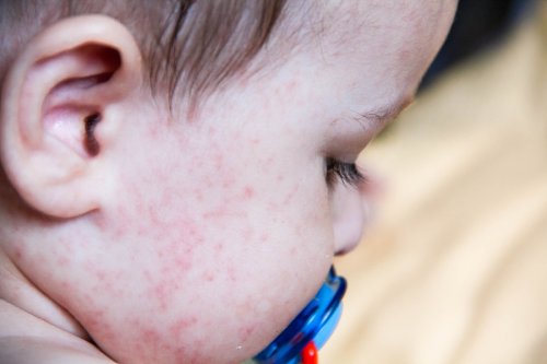 Las inflamaciones de la piel son síntomas de las alergias alimentarias comunes en niños.