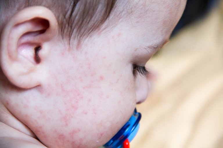 Alergias alimentarias comunes en niños