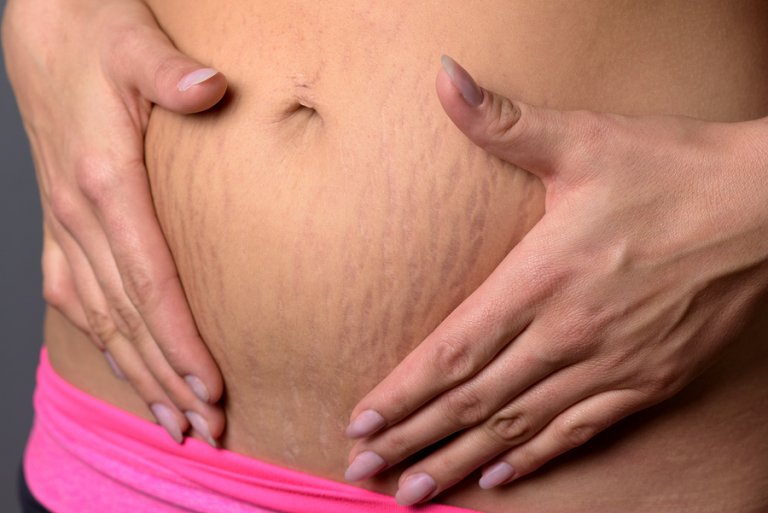 Defectuoso Disparidad Nuevo significado Cómo eliminar las estrías durante el embarazo? - Eres Mamá