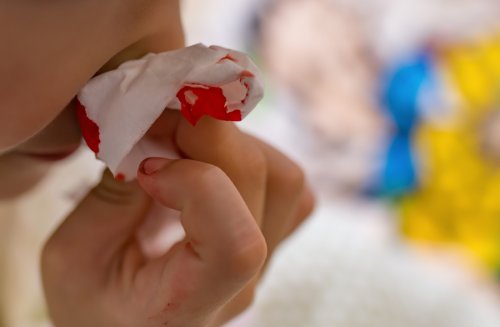 A mi hijo le sangra mucho la nariz. ¿Qué debo hacer?