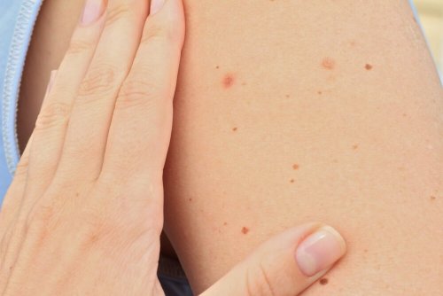 Existen dos tipos de lunares según su forma: los lisos, que suelen ser los más recurrentes, y también los que presentan elevación.