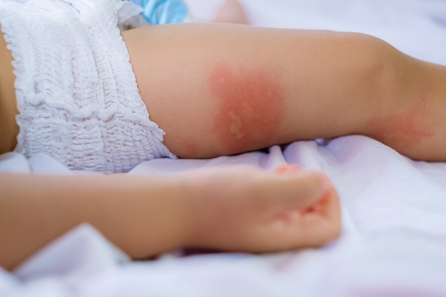 Cómo tratar la dermatitis del - Eres Mamá