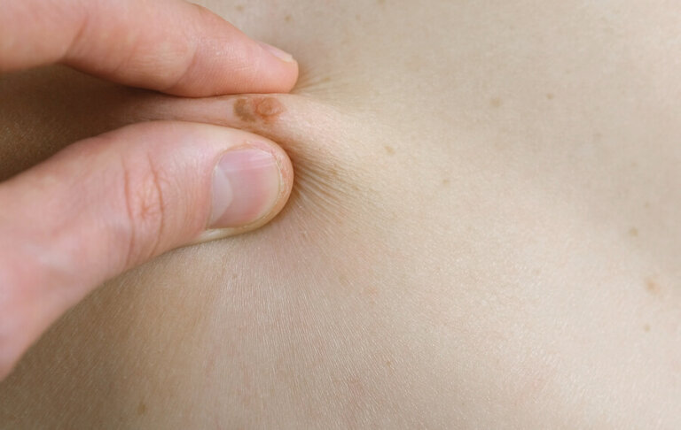 Tipos de lunares: cómo identificarlos