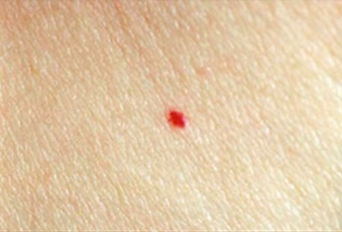 Los diferentes tipos de lunares pueden representar diferentes riesgos.