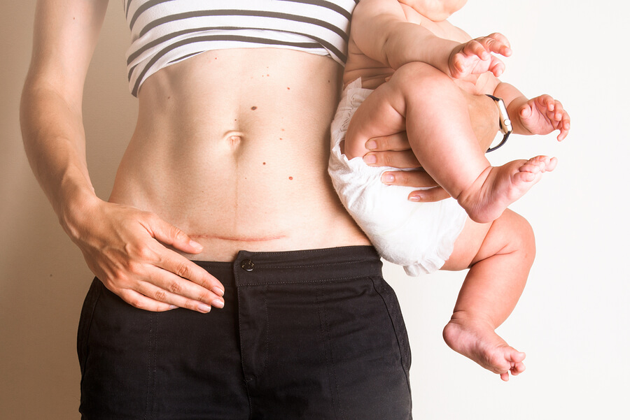 A woman with a C-section scar holding a baby.