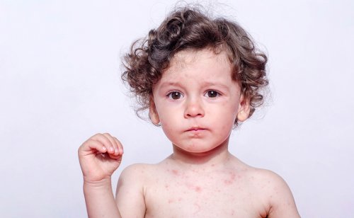 Un enfant qui présente une réaction cutanée.