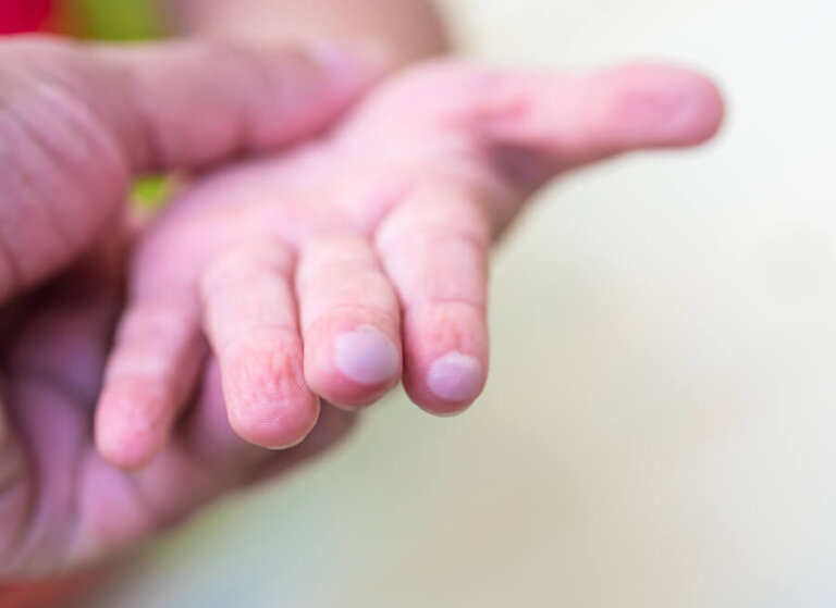 Ampollas en niños, ¿cómo curarlas?