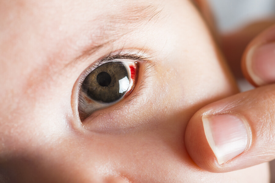 Sastre puño diámetro Qué son las manchas rojas en los ojos del bebé? - Eres Mamá