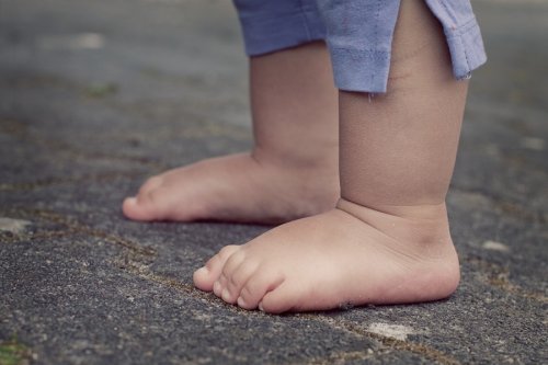 Acondroplasia en niños