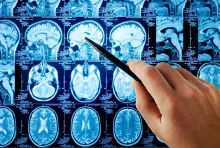 Adenomas hipofisarios y su influencia en el embarazo