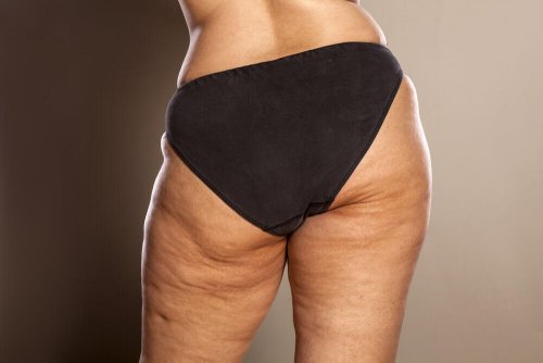 ¿Sabes cómo combatir la celulitis estética?