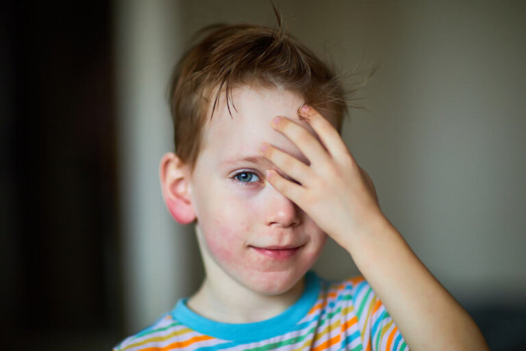 La dermatomiositis infantil