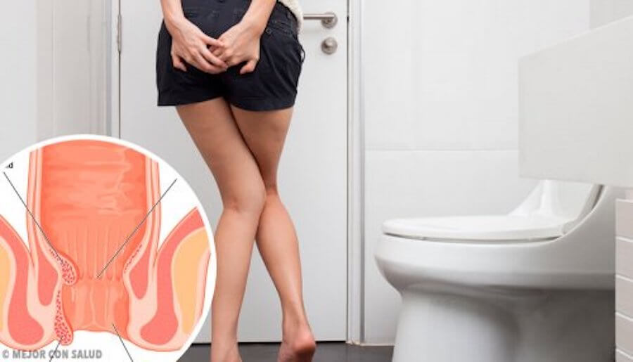Tratamientos naturales para las hemorroides