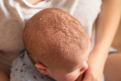 Dermatitis seborreica infantil.