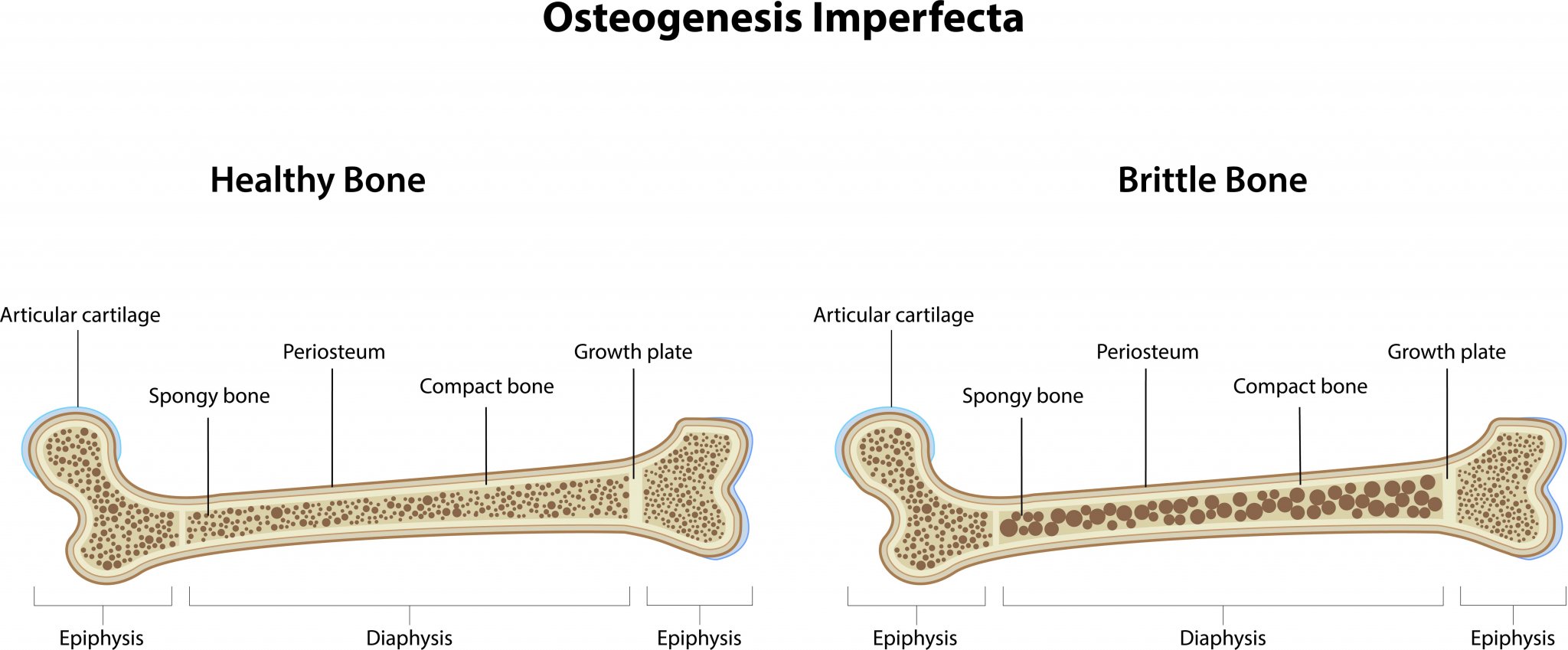 La osteogénesis imperfecta en los niños Eres Mamá
