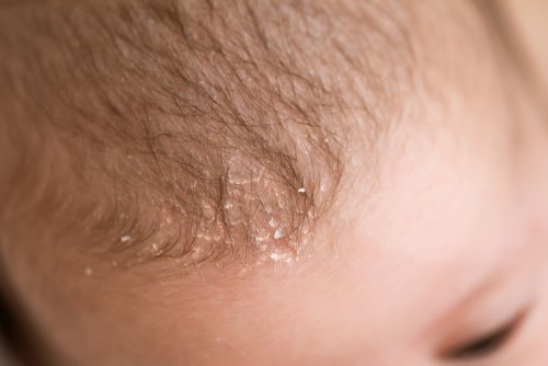 Bebé con costra láctea o dermatitis seborreica.