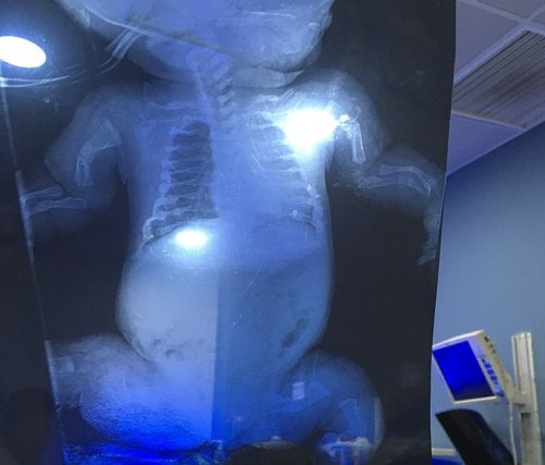 Radiografía de un bebé con osteogénesis imperfecta.