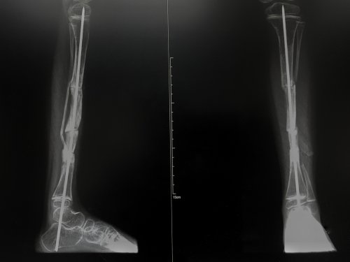 La osteogénesis imperfecta en los niños