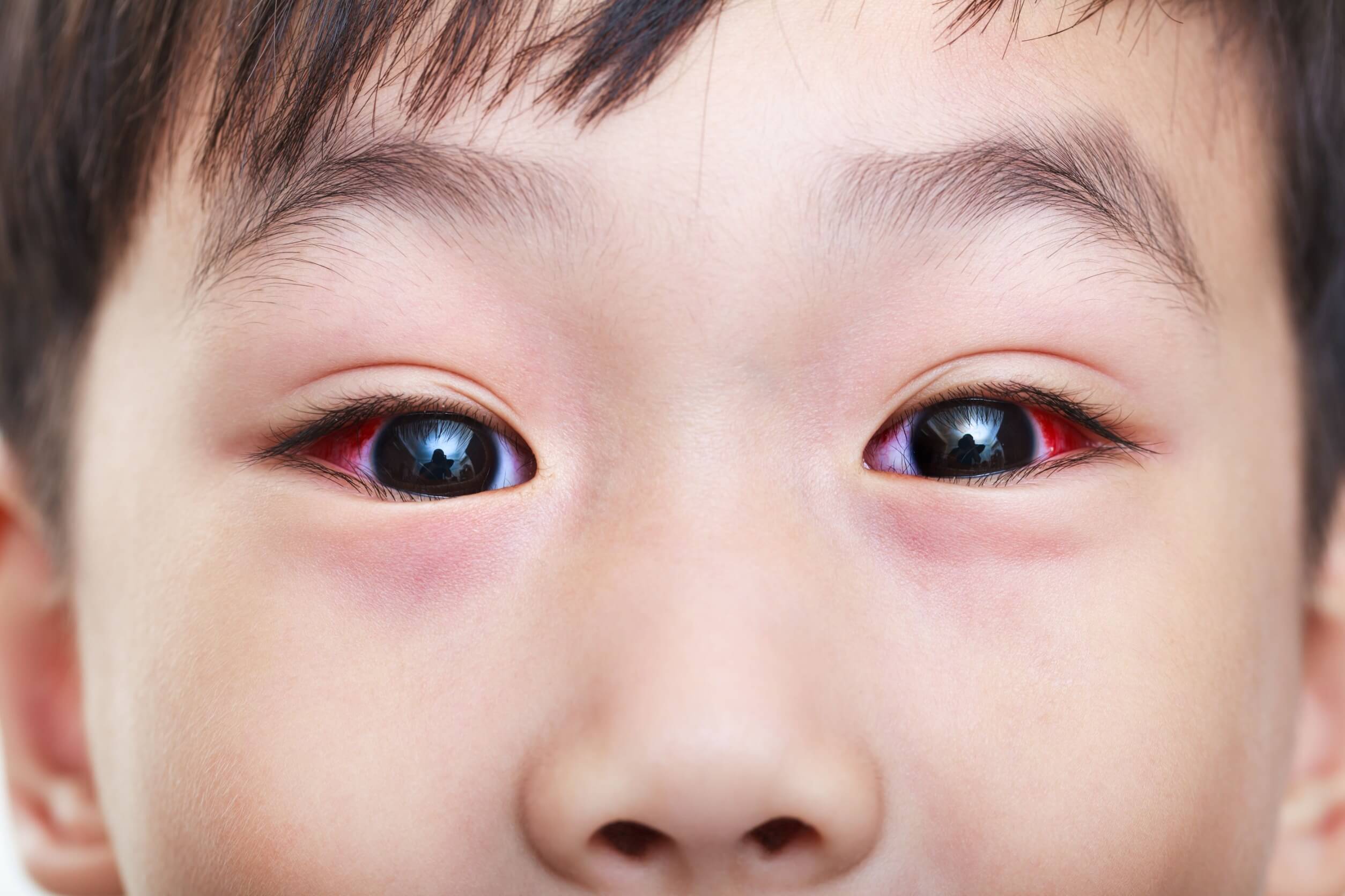 Los derrames oculares en niños se confunden