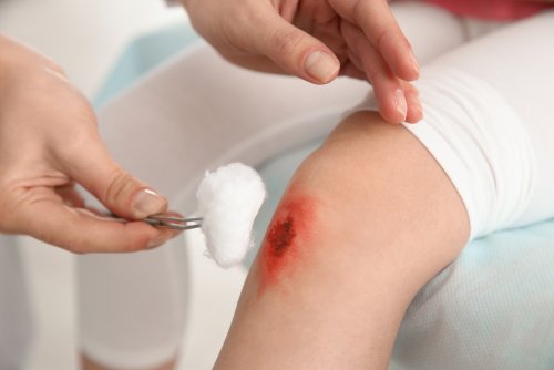 Médico usando antisépticos y desinfectantes para curar una herida en la rodilla de un niño.