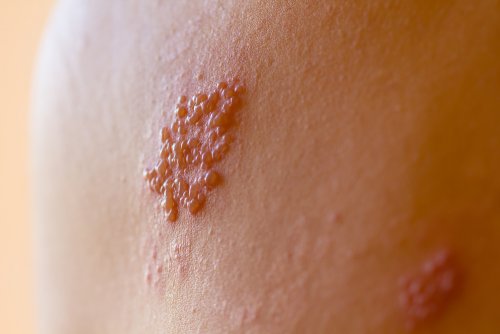 El herpes zóster en niños
