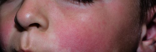 Las enfermedades exantemáticas en la infancia.