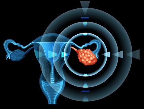Cáncer de ovario: ¿es hereditario?