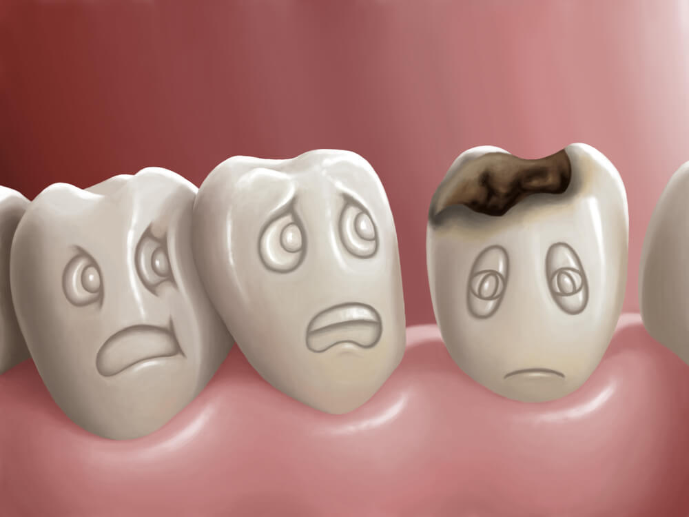 Cosa sono le carie dentali e come possono essere prevenute?