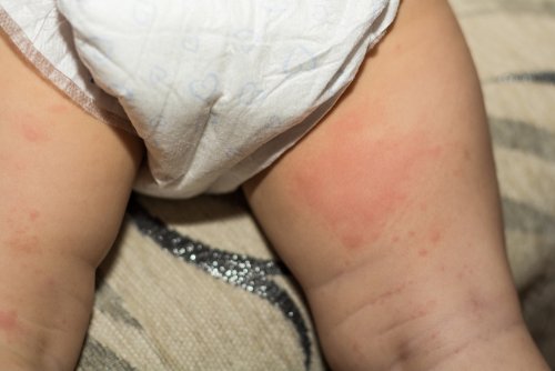 Dermatitis seborreica infantil