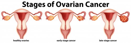Cáncer de ovario: ¿es hereditario?